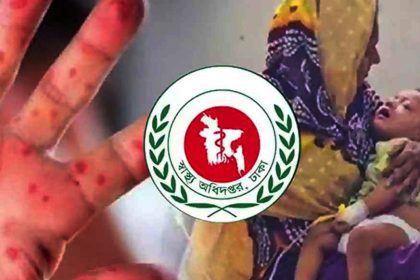 হাম উপসর্গে আরও ৭ শিশুর মৃত্যু