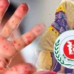 হামের উপসর্গে ১১ জন শিশুর মৃত্যু