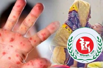 হামের উপসর্গে ১১ জন শিশুর মৃত্যু