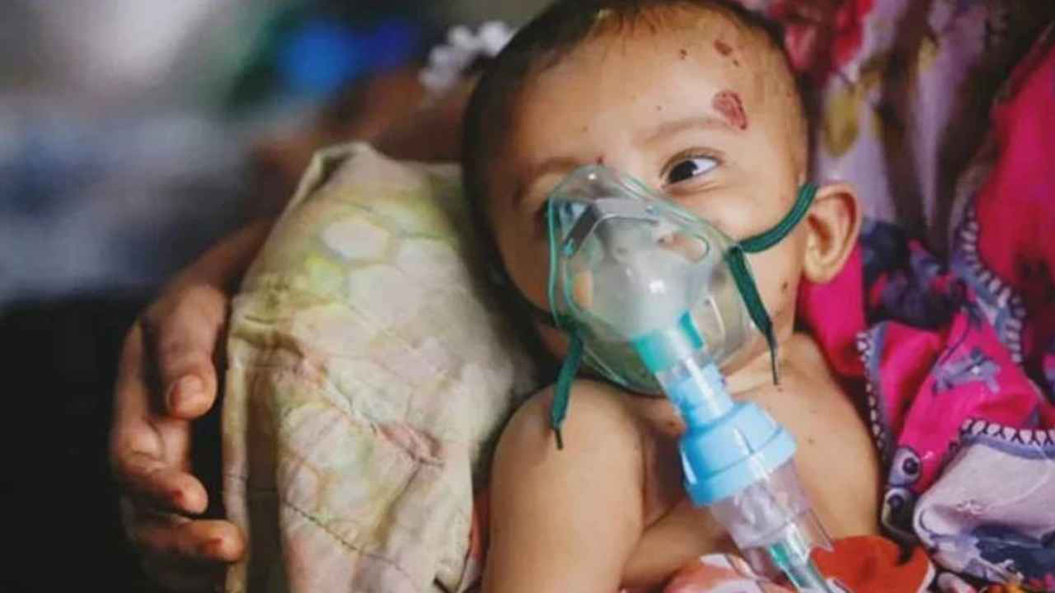 দেশে গত ২৪ ঘণ্টায় হাম উপসর্গে সাতজন শিশুর মৃত্যু